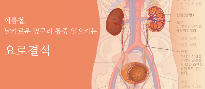 여름철 날카로운 옆구리 통증 일으키는 요로결석 (새창보기)