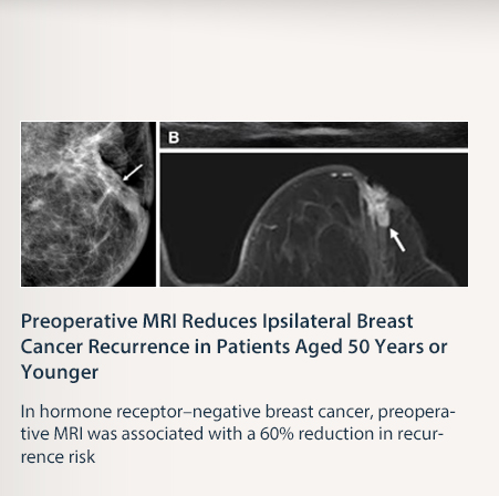 Preoperative MRI Reduces Ipsilateral Breast Cancer Recurrence in Patients Aged 50 Years or Younger  In hormone receptor&ndash;negative breast cancer, preoperative MRI was associated with a 60% reduction in recurrence risk