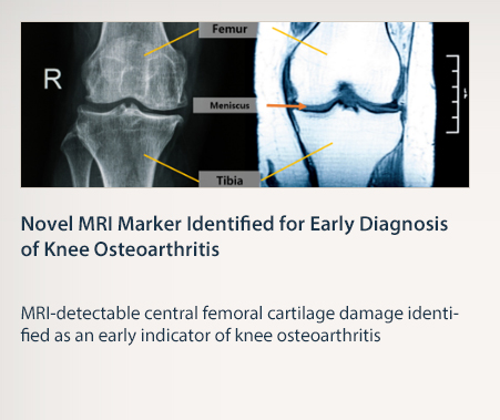 Novel MRI Marker Identified for Early Diagnosis of Knee Osteoarthritis  MRI-detectable central femoral cartilage damage identified as an early indicator of knee osteoarthritis