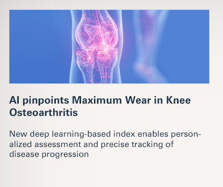 AI pinpoints Maximum Wear in Knee Osteoarthritis  New deep learning-based index enables personalized assessment and precise tracking of disease progression  READ MORE 